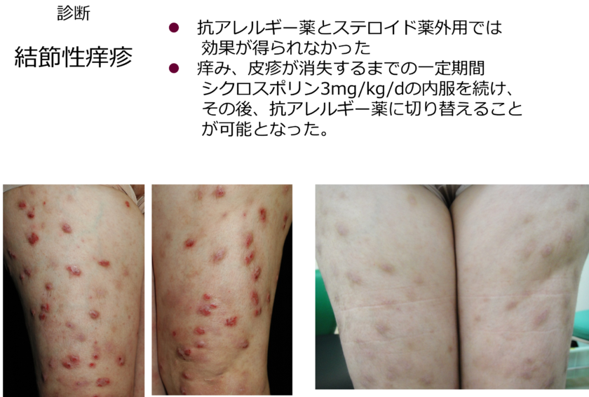 デュピクセントの軽度の副作用